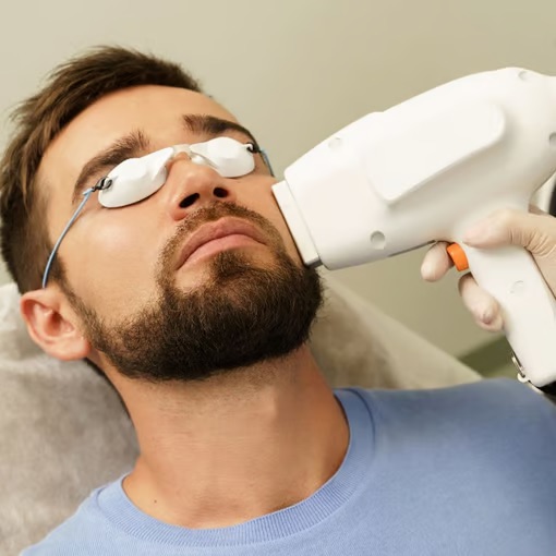 Depilação a laser para a barba